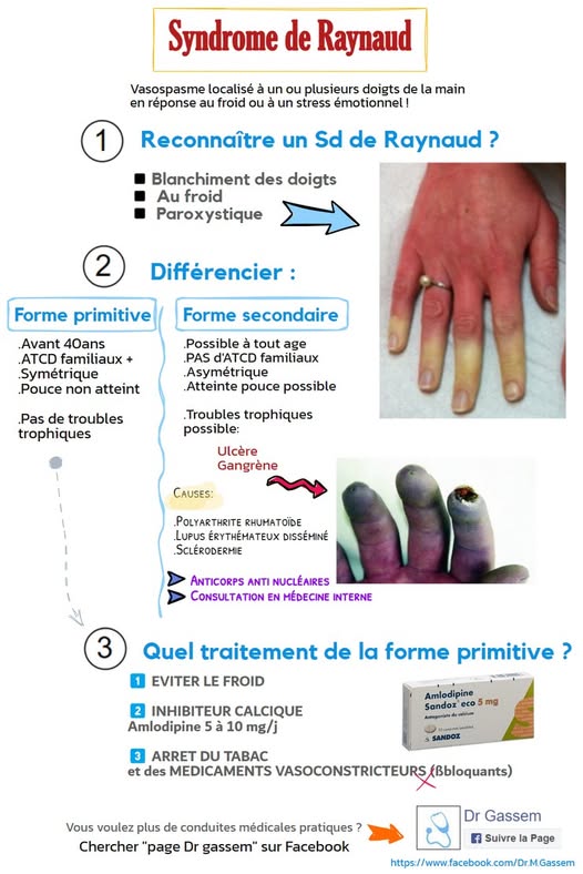 Syndrome de RAYNAUD